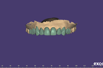 design highly aesthetic crowns and veneers using exocad