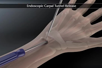 create 3d orthopedic implant and surgical device animation