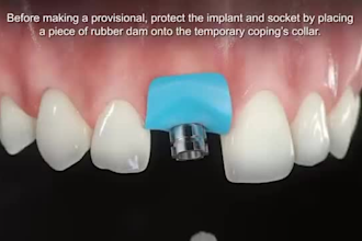 3d dental implant,3d teeth animation video 3d teeth surgery procedure 3d dental,