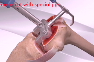 do 3d medical animation orthopedic surgery animation knee replacement animation