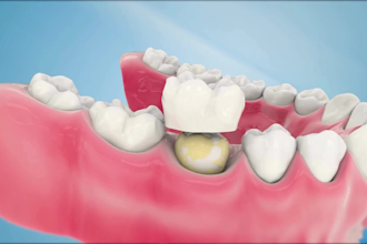do 3d dental crown implant animation, oral surgery explainer and medical device