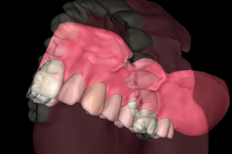 design digital total prostheses using exocad