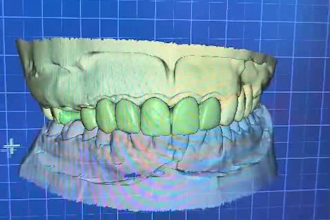 design crowns, bridges and implants professionally in exocad