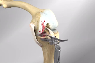make medical animation 3d knee replacement acl reconstruction orthopedic surgery