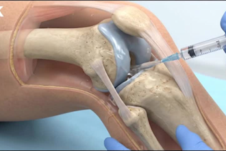 3d ai medical animation, patient education, medical explainer, healthcare video