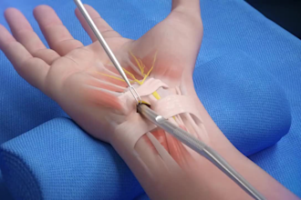 create 3d medical surgical animation for endoscopic carpal tunnel medical device