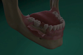 create 3d dental implant, surgery explainer and tooth treatment animation video