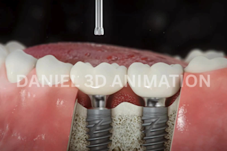 do 3d dental implant animation 3d abutmen crown explainer and surgery procedure