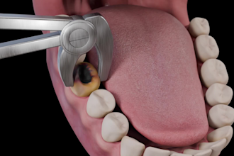 create medical animation dental implant procedure  cavity filling animation