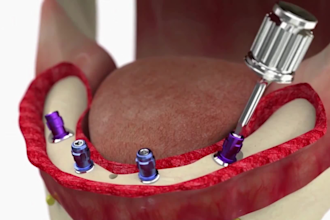 3d medical video oral cosmetic surgery animation dental implant web 3d video ads