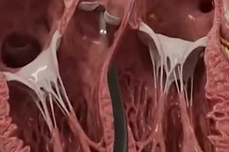 3d medical animation, 3d surgical procedure anatomy medical explainer