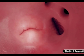 create realistic 3d medical animation medical device surgery explainer video