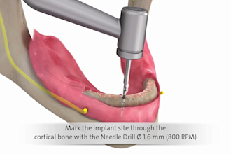 do 3d dental implant animation, medical equipment animation and explainer video