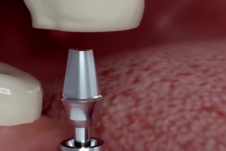 create 3d dental procedure and medical education explainer animation videos