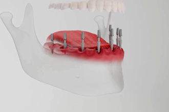 create 3d medical animation dental implant surgical teeth restoration videos