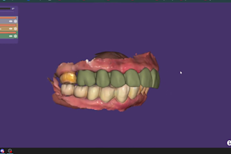 3d digital design in exocad