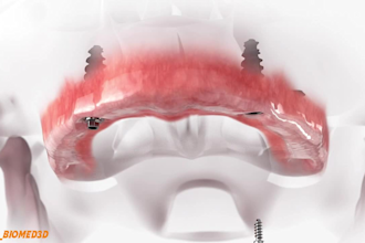 create 3d dental implant animation and oral surgery videos