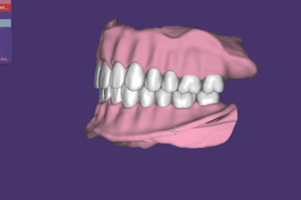 design exocad crowns and bridges for you accurately