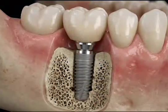 create 3d dental animation for implants, oral surgery and procedures