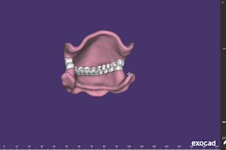 design crowns, bridges, implants, dentures using exocad