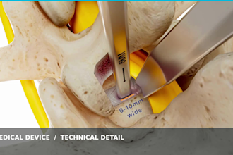 create 3d medical device animation, surgical procedure visualization
