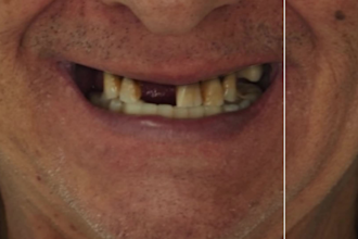 puedo diseñar coronas, puentes y restauraciones sobre implantes en exocad