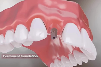 do 3d dental implant animation, patient education, explainer video