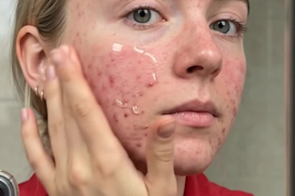 create realistic ai ugc ads for skincare and acne prone skin