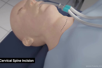 do 3d cervical disc replacement spine surgery animation and medical explainer