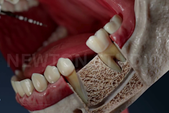do 3d dental implant animation 3d medical device animation 3d implant surgery