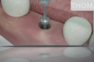 do 3d dental implant animation 3d medical device 3d implant surgery videos