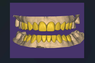 design crowns, bridges, veneers, all on x in exocad