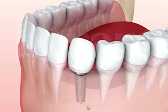 create 3d dental implant animation implant procedure and crown restoration video
