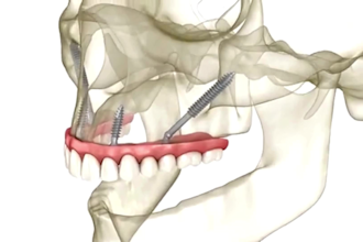 create 3d dental implant animation, orthodontic and root canal explainer video