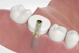 3d dental animation dental implant socket procedure bone graft explainer video