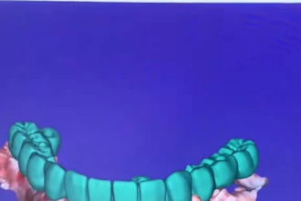 create realistic cad cam dental designs using exocad