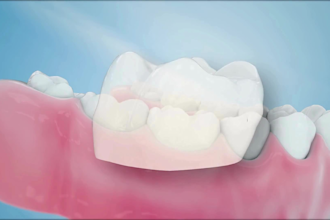 do 3d dental animation for dental crown, implant procedure and patient education