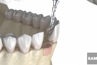 create 3d medical device, 3d implant animation for sales demos