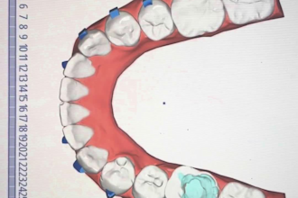 create a professional clear aligner orthodontic treatment plan on onyxceph 3d