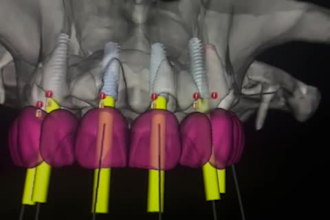 design surgical guides for dental implants and full arch