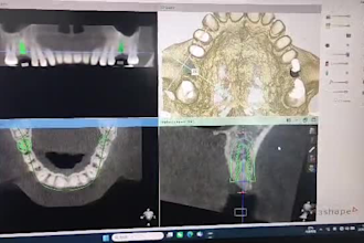 design custom dental surgical guides for implant surgery