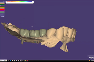 design implant crowns, custom abutments, and aox restorations in exocad