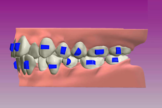 make clear aligner with 3shape