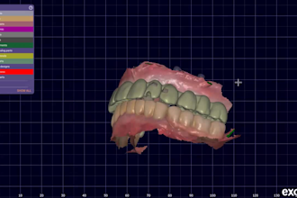 design full arch all on x prosthesis