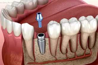 do 3d dental animation procedure animation orthodontic video