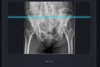 develop ai bone fracture detector with website