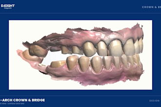 design dental crowns bridges copings and veneers in exocad 3shape