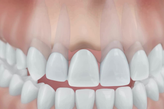 create realistic 3d medical animation, dental animation, dental implant video