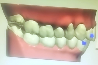 do dental clear aligner treatment planning on 3shape