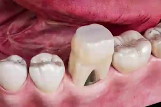 do 3d medical animation, 3d dental medical device surgery animation 3d model